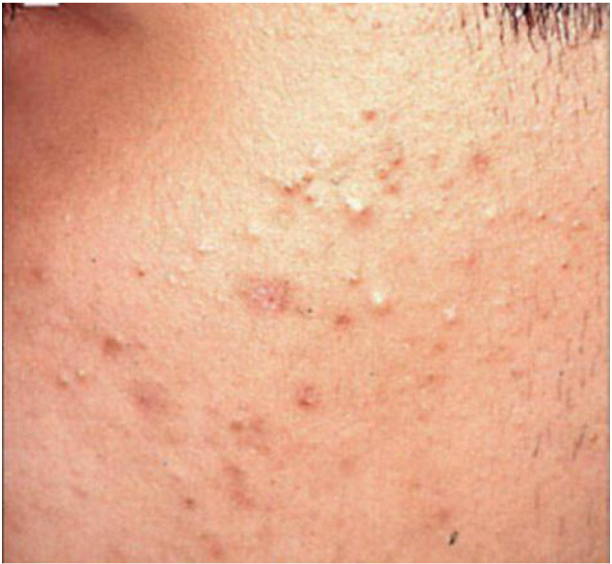 Acne comedonica