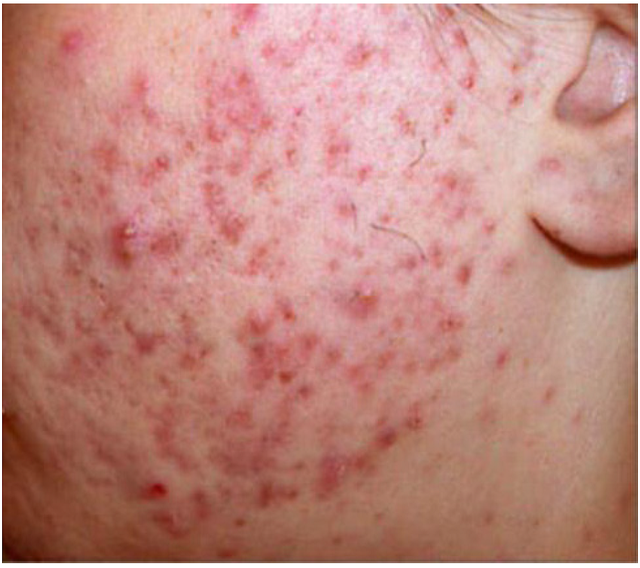 Acne papulopustulosa