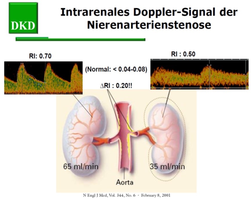 intrarenales Dopplersignal