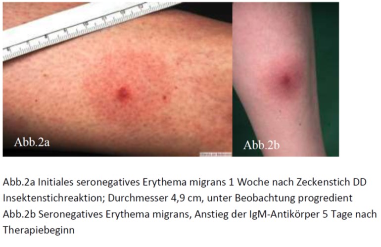 typisches Erythema migrans